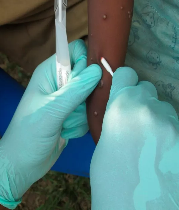 Laboratory testing for the Monkeypox virus | PULSE CLINIC - Asia's ...