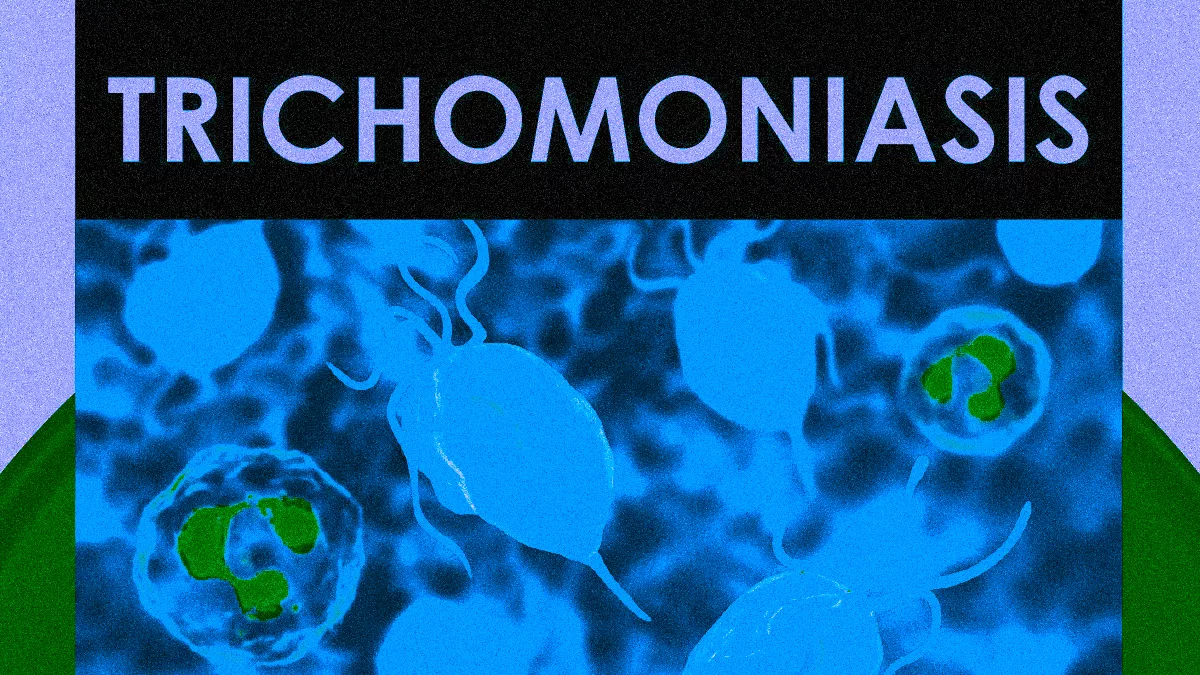 TRICHOMONIASIS